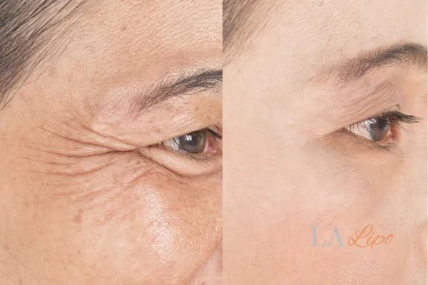 Before and after results of woman - HI-fu wrinkles reduction treatment Isle of Isla