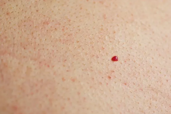 close up of a cherry angioma Isle of Isla