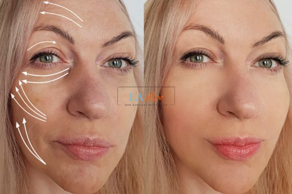Morpheus 8 results Isle of Isla face lift.