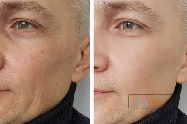 See the amazing results of Morpheus8 Treatment Isle of Isla!