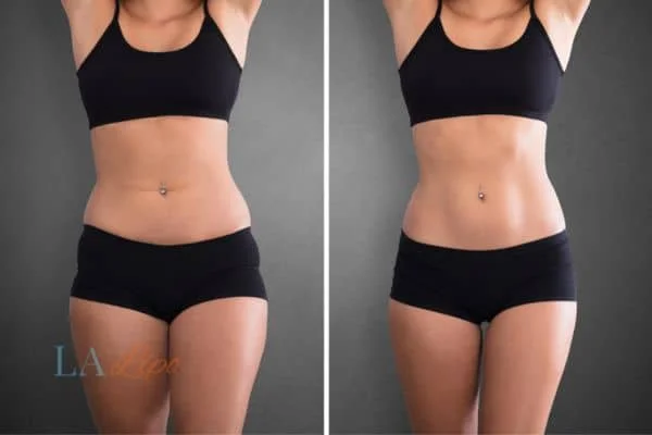 before and after results of non-surgical treatment to help a woman's body image and mental health Isle of Isla